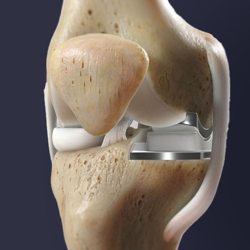 Est une option chirurgicale utilisée pour traiter l'arthrose qui est limitée à un seul compartiment du genou